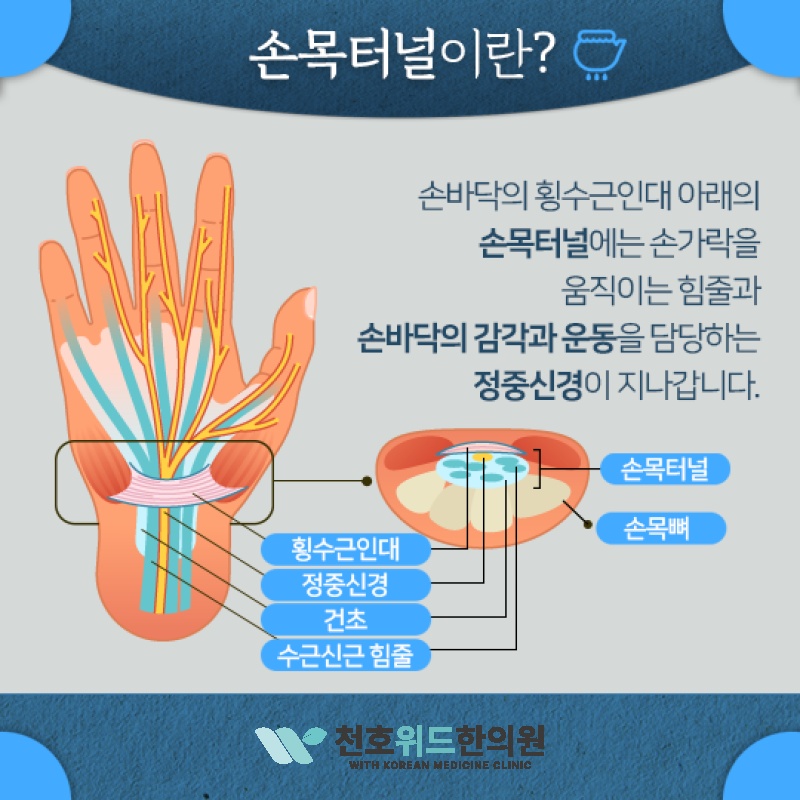 손목터널증후군, 저림이 되풀이될 때 살펴볼 점