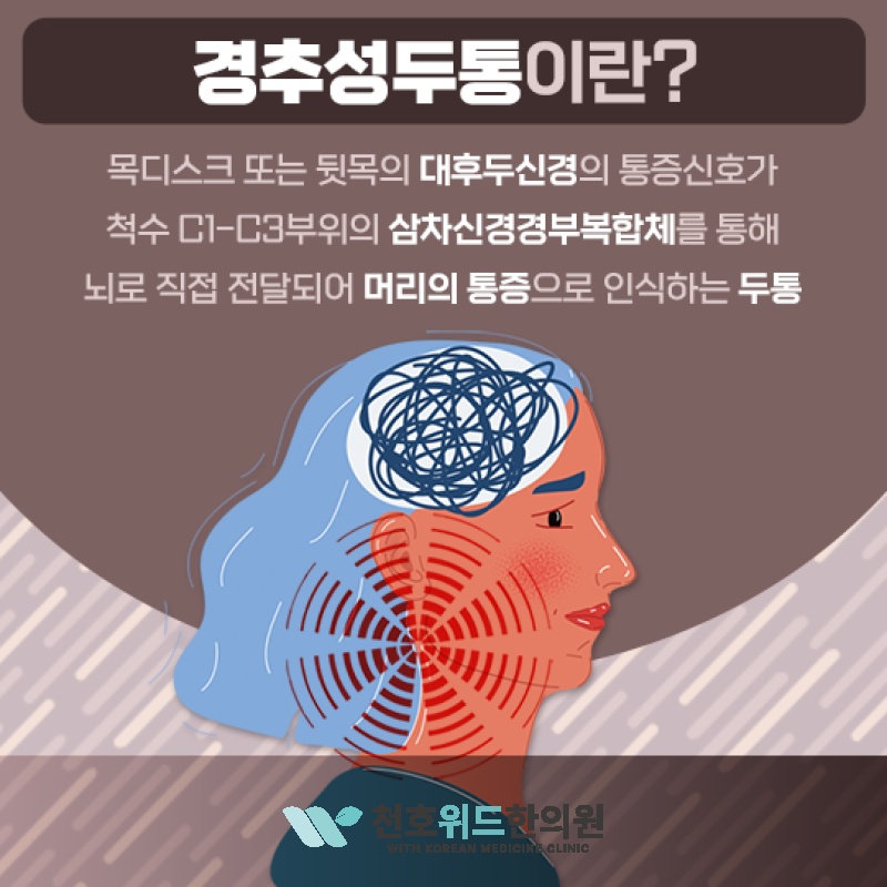 뒷목과 어깨가 뻣뻣한 일상, 경추성두통과 관련 있을까요