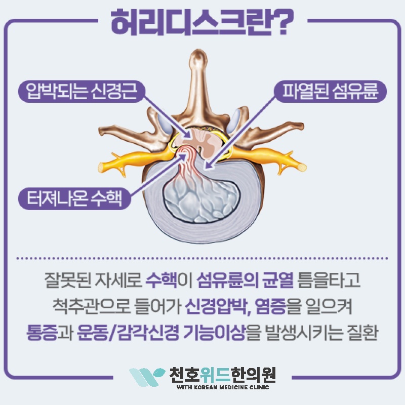 장시간 앉아 지내는 직장인, 허리디스크 주의가 필요합니다