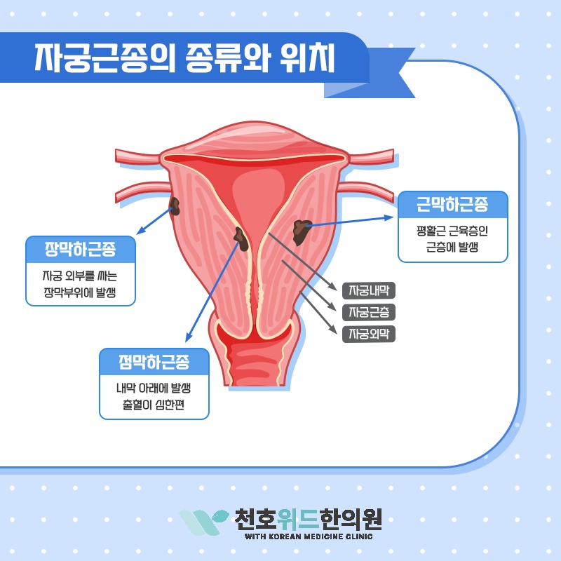 자궁근종의 크기 변화를 살피며 관리하는 방법