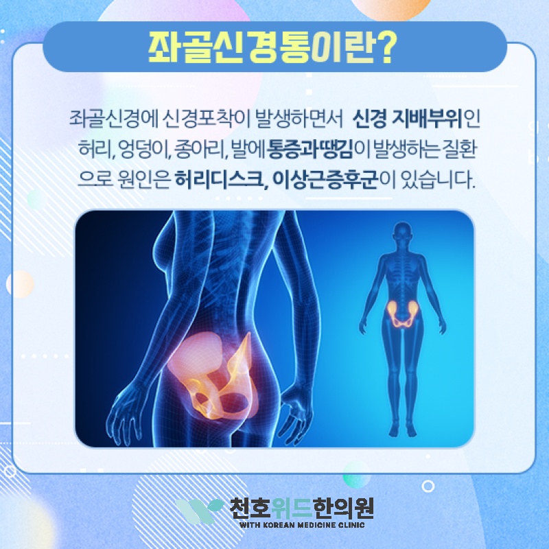 허리를 굽히거나 펴기 어려울 때 좌골신경통 살펴보기