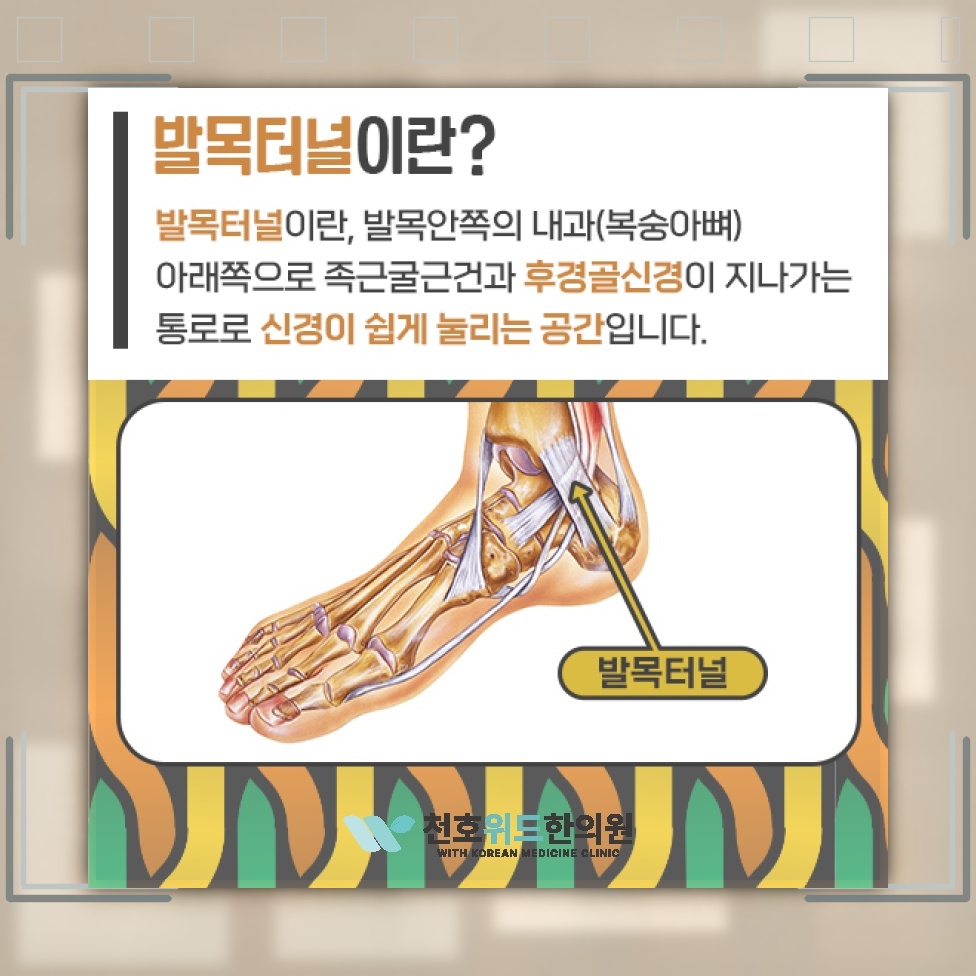 발바닥이 화끈거리는 증상과 발목터널증후군의 관계