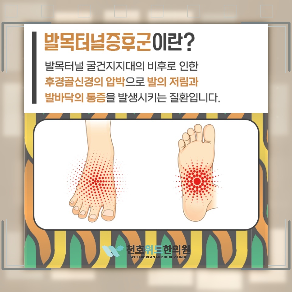 발바닥이 화끈거리는 증상과 발목터널증후군의 관계