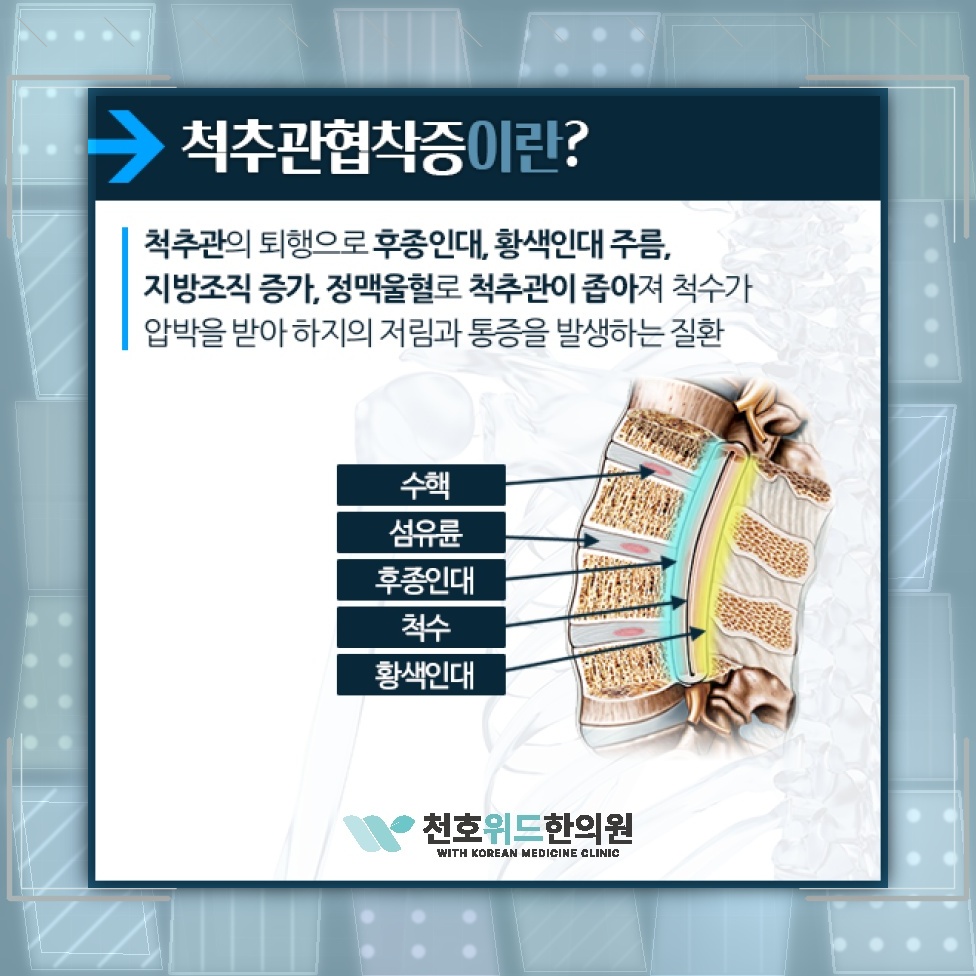 척추관협착증의 퇴행성 진행을 살피는 생활 관리