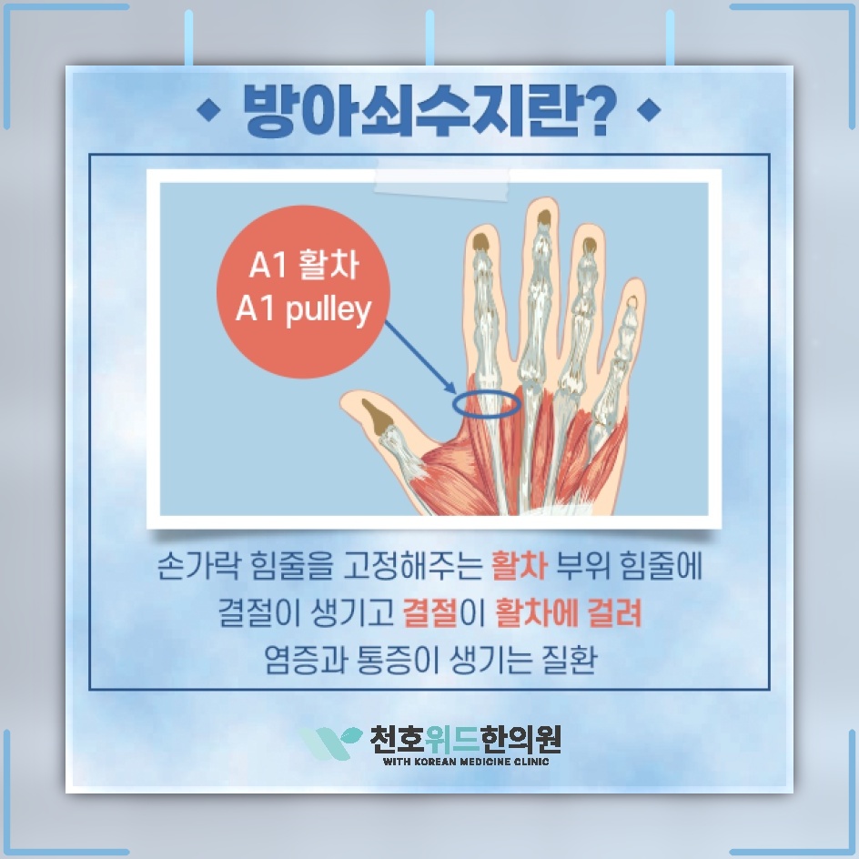 손가락을 펼 때 걸리는 느낌, 방아쇠수지의 주요 증상