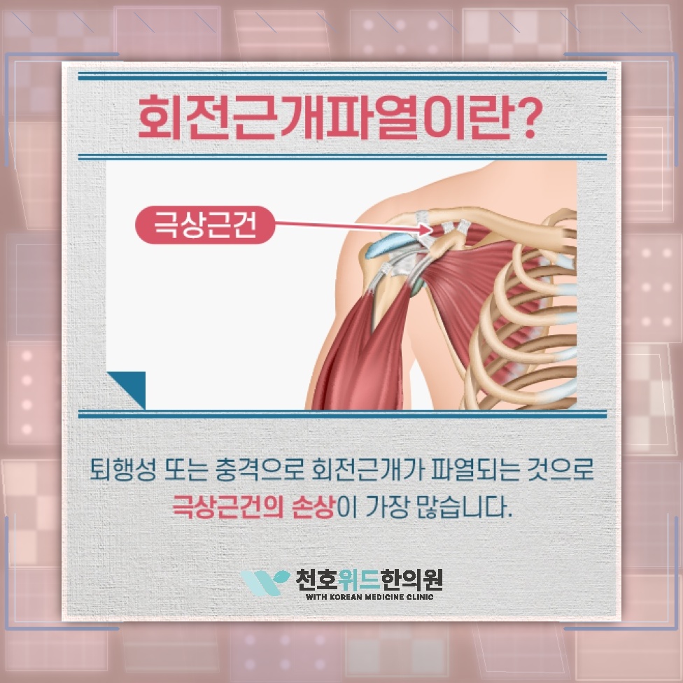 회전근개파열 뒤 지속되는 어깨 힘줄 염증의 원인