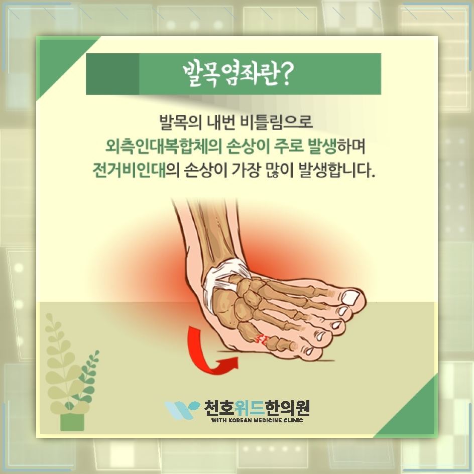 발목염좌 뒤 약해진 인대가 관절 불안정으로 이어질 때