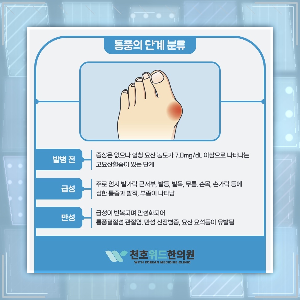 발가락 관절에 흔히 나타나는 통풍의 주요 발생 부위