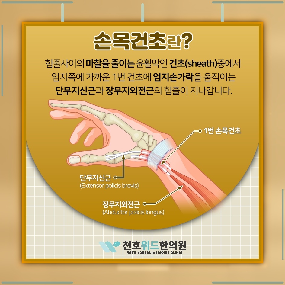 반복 동작과 과도한 사용으로 생기는 손목건초염